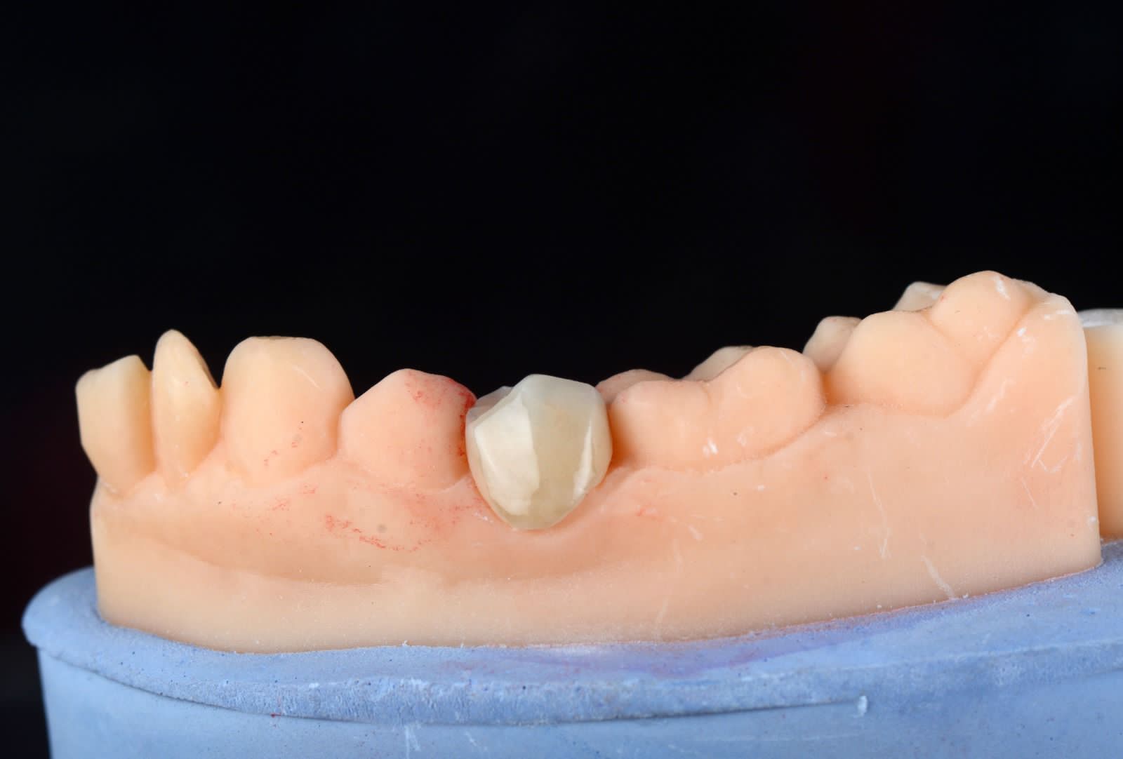 Single crown seated on a working model from the side