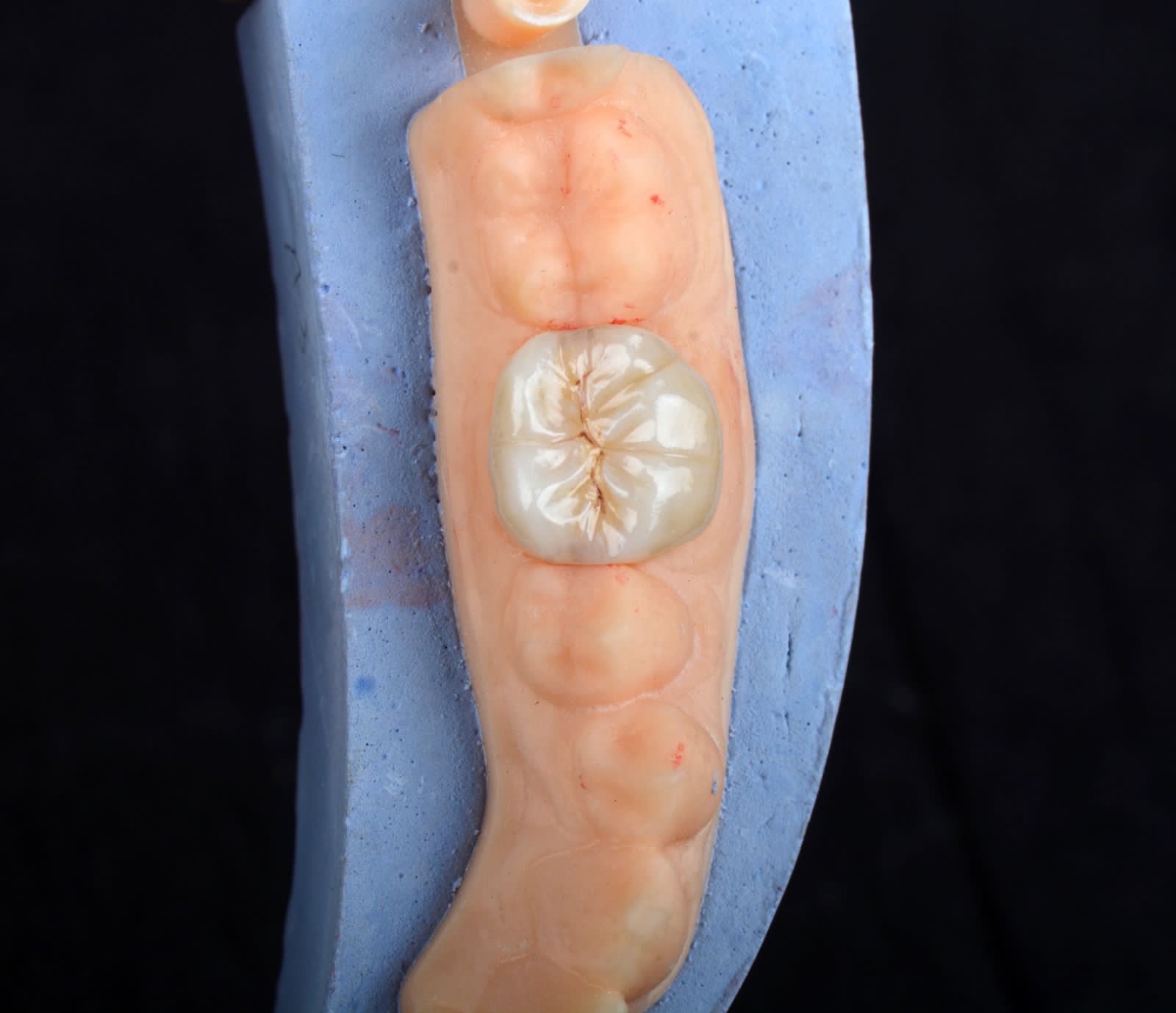 Posterior zirconia crown seated on a working model