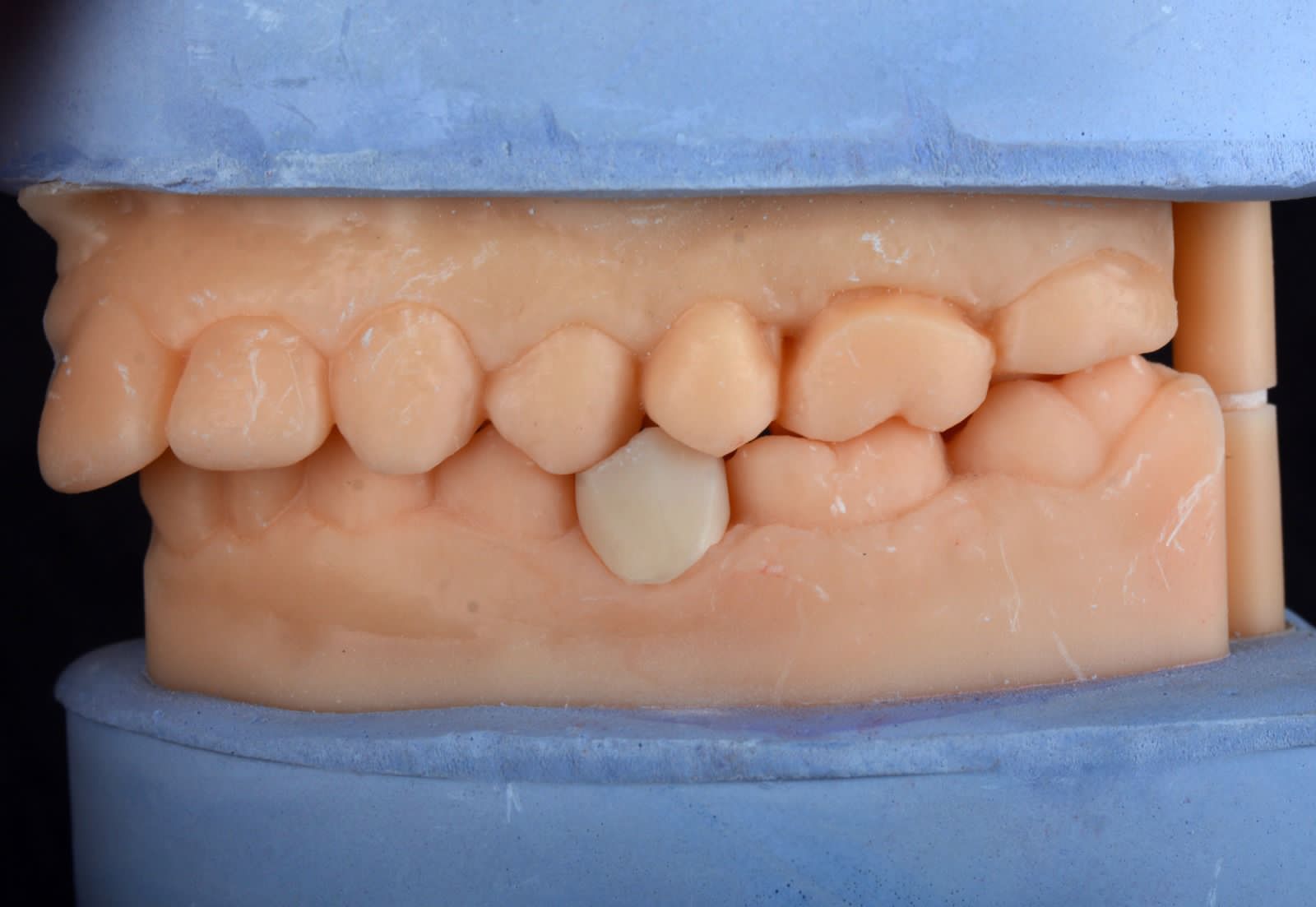 Single crown seated accurately within full arch occlusion