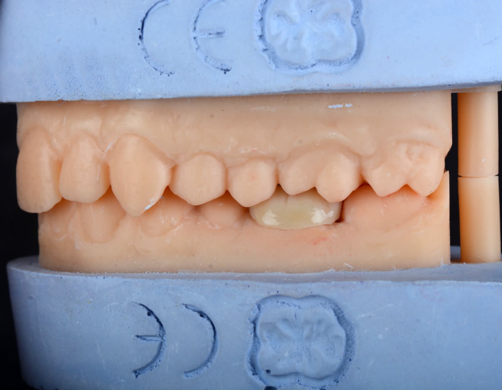 Single crown in occlusion on a working model