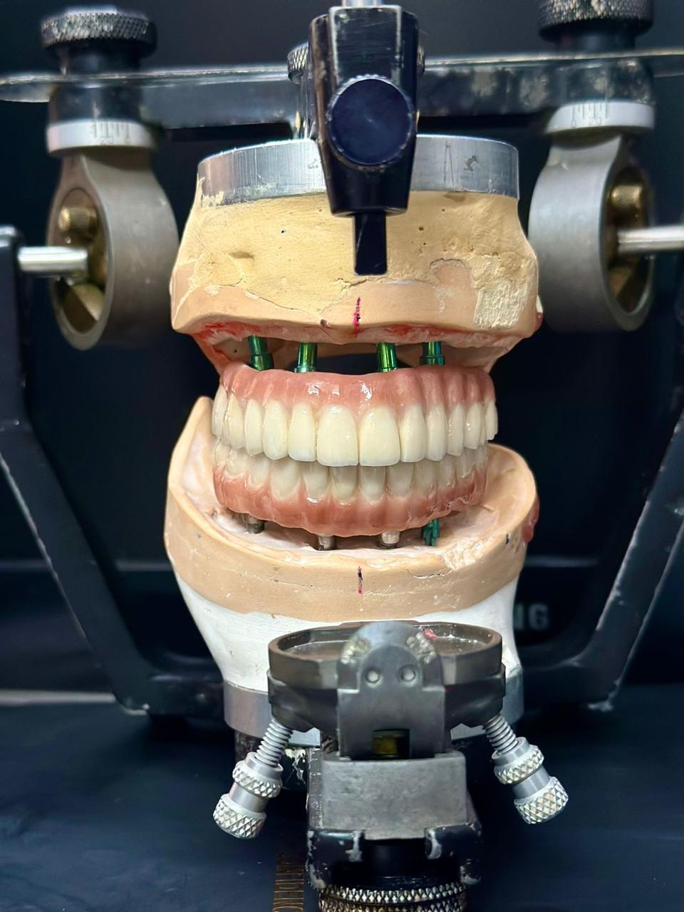 Full-mouth implant setup mounted on an articulator