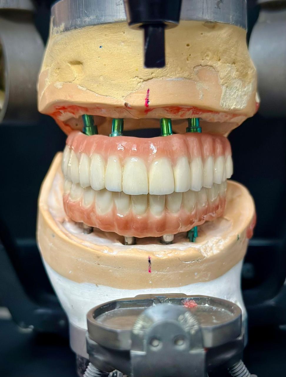 Full-mouth implant restorative case on a clinical model