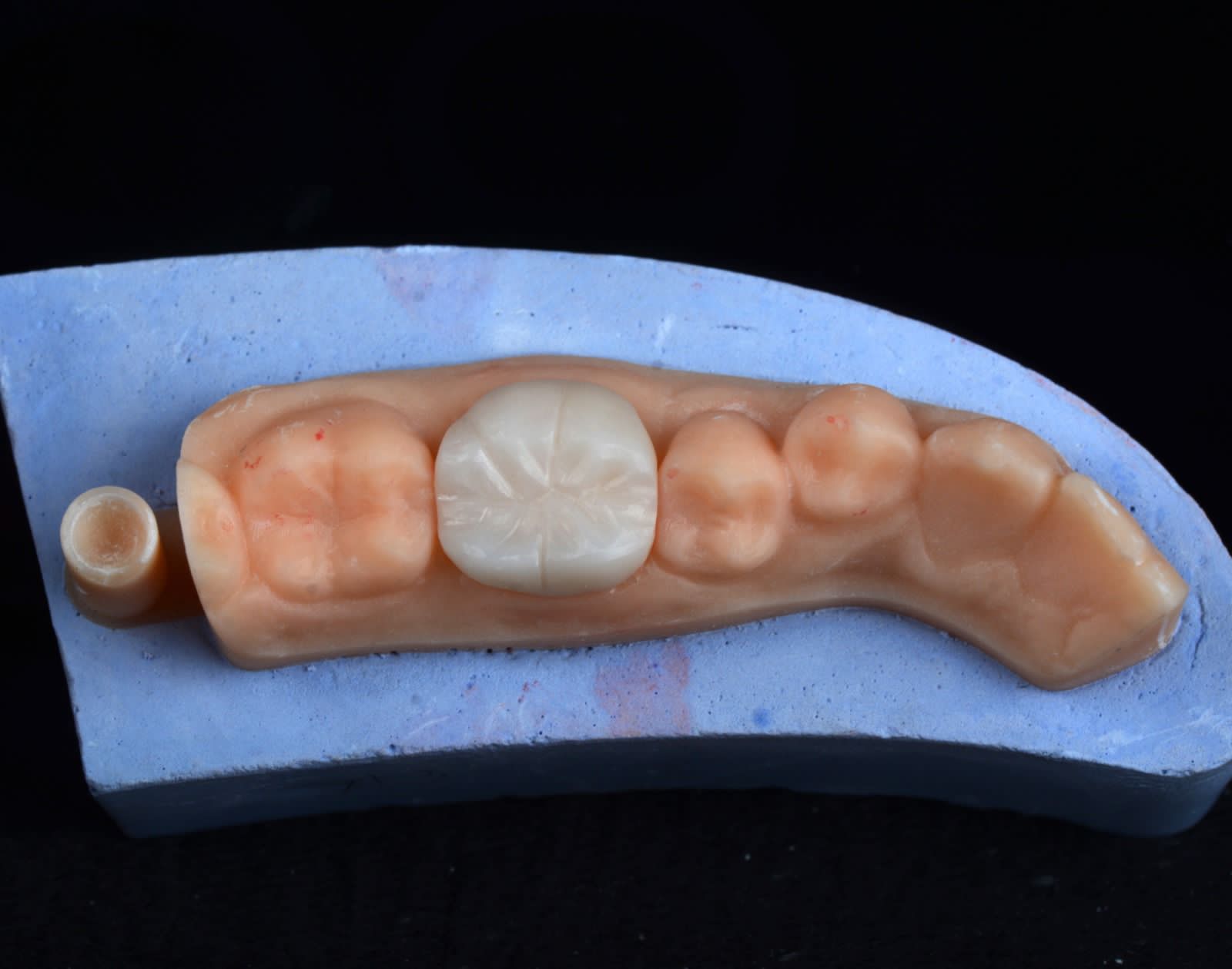 Posterior crown seated on a working model